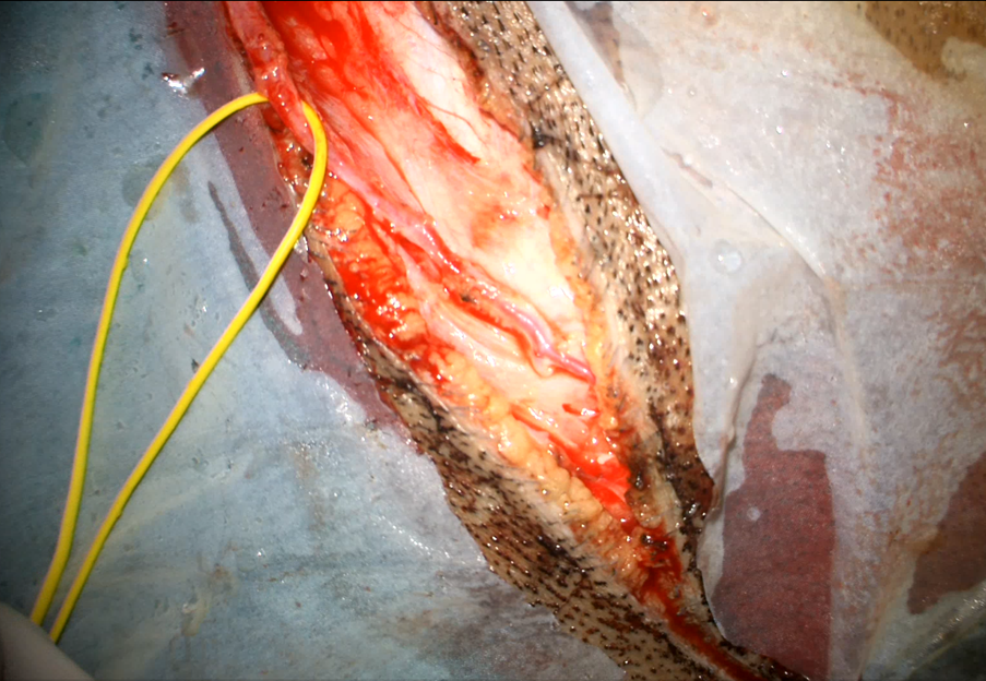 Figure 5. Patient positioning for left pterional craniotomy- extended and rotated slightly to the opposite side]